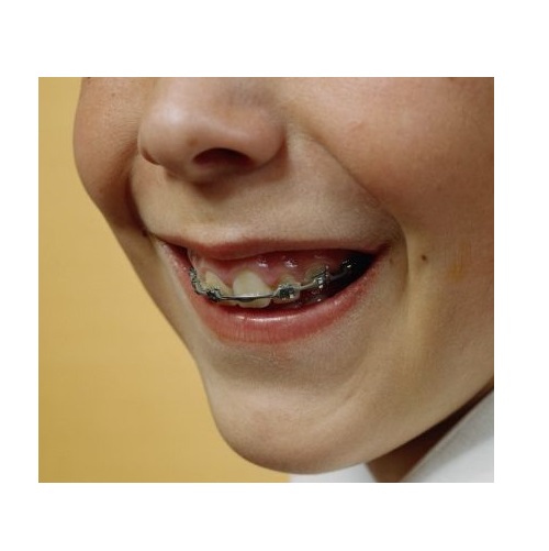 wear braces in verbal behavior  category